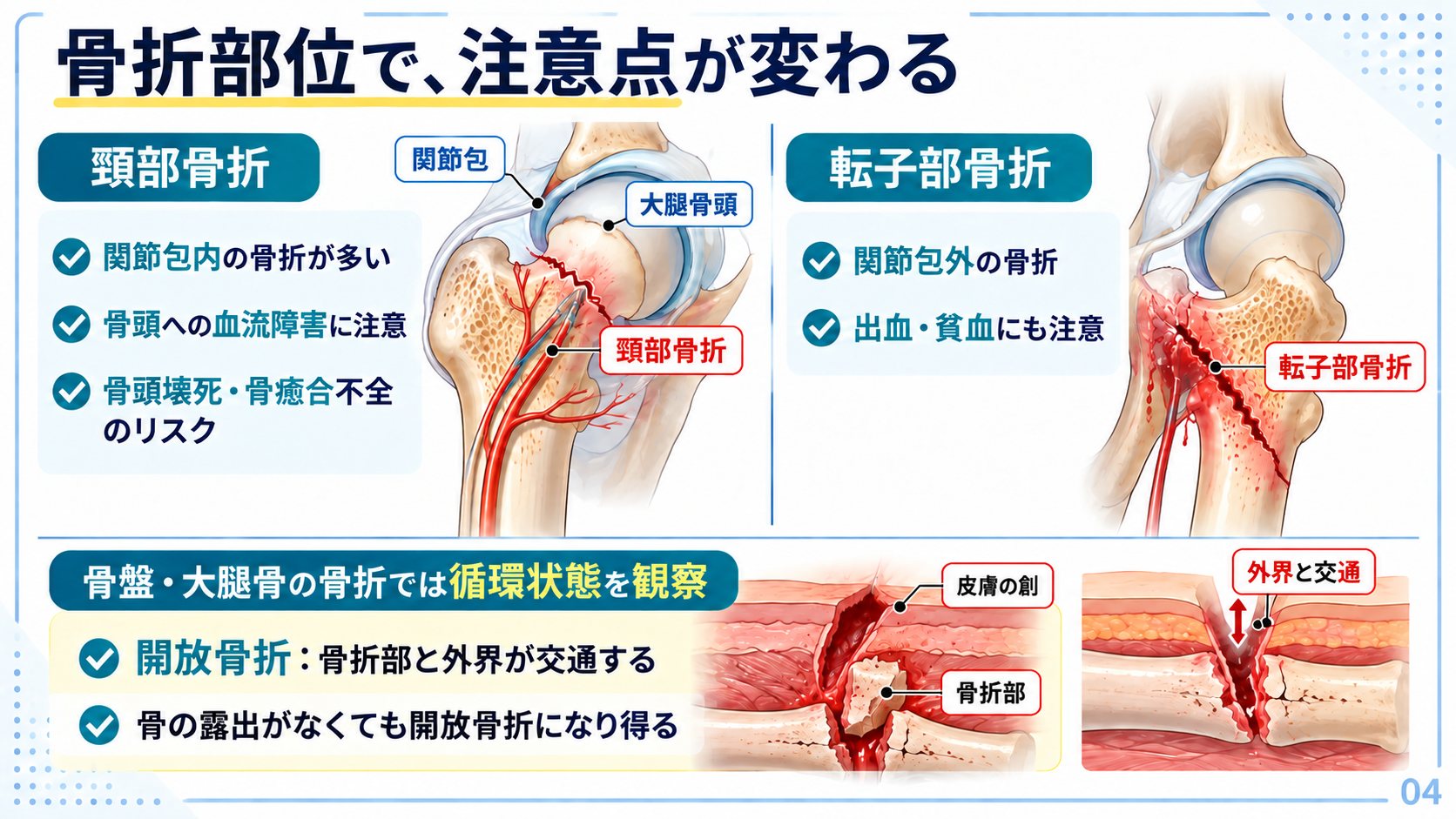 大腿骨近位部骨折の比較:頸部骨折(関節包内・骨頭壊死のリスク)と転子部骨折(関節包外・出血に注意)