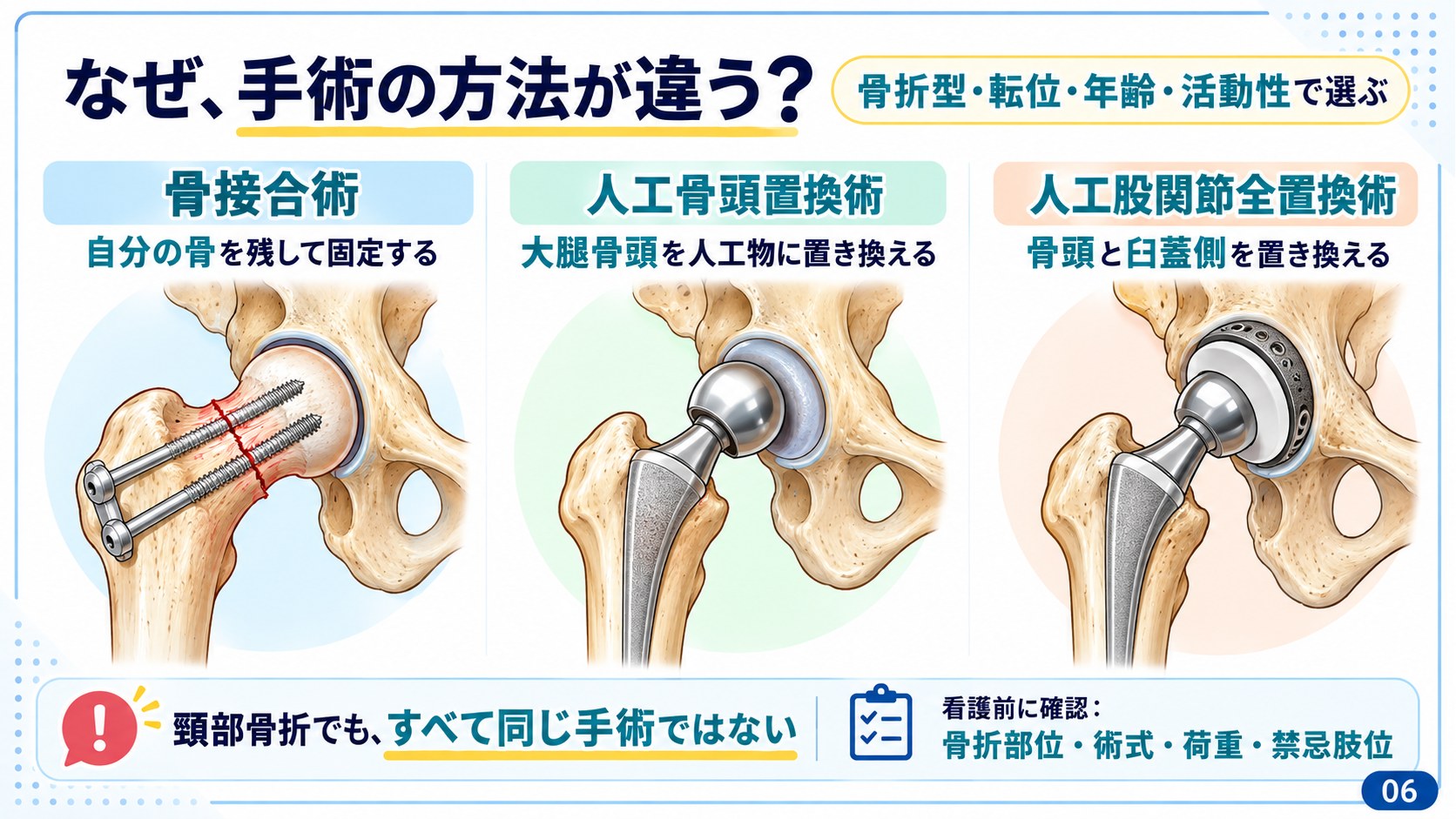 3つの術式の比較:骨接合術、人工骨頭置換術、人工股関節全置換術の違い