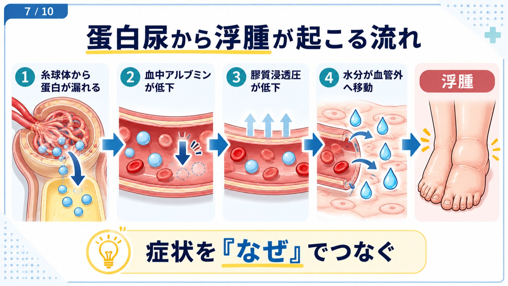 蛋白尿から浮腫が起こる流れ